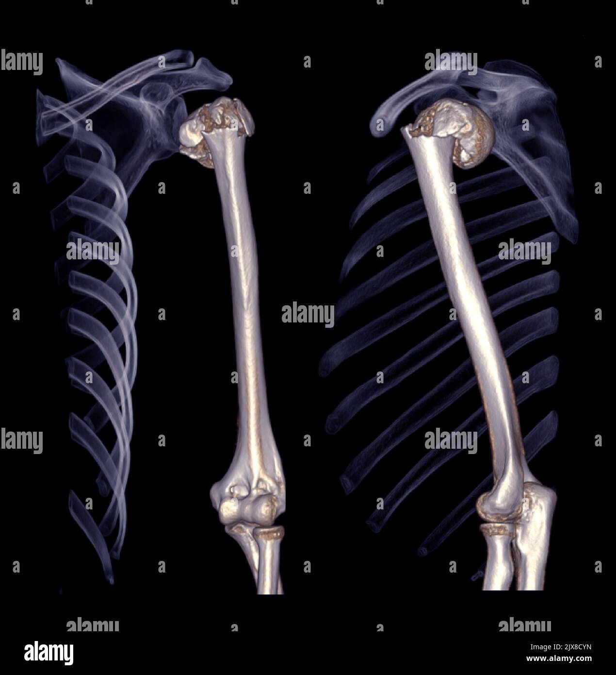 Computed Tomography Volume Rendering examination of the shoulder joint ...