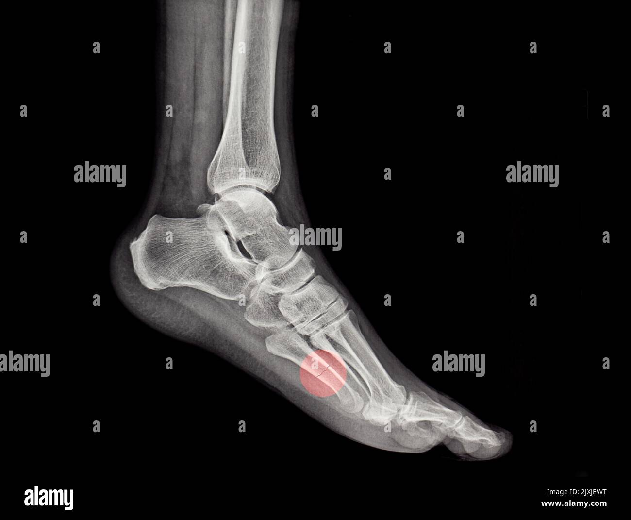 an xray of a human metatarsal bone fracture, diagnosis, broken Stock