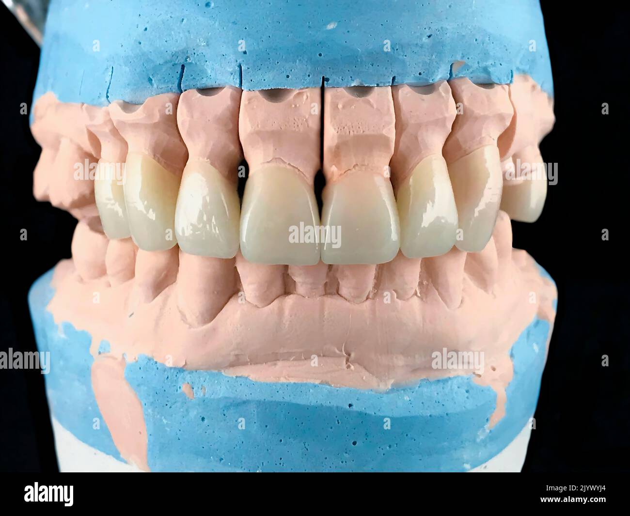 Dental porcelain prosthesis implant tooth in dental laboratory. Front view. Selective focus. Lower and upper jaw in metal occluder. Dental gypsum Stock Photo