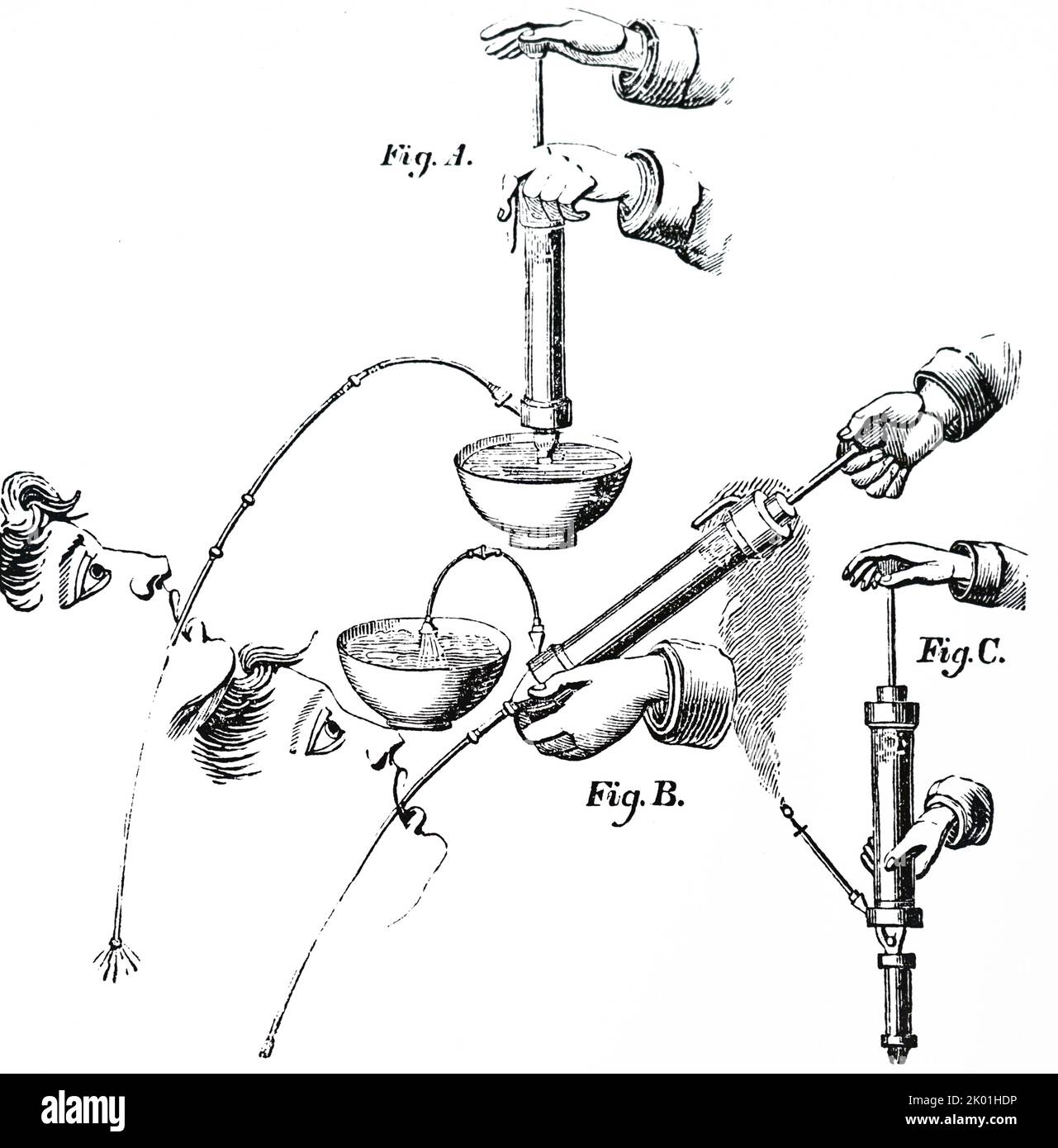 Reed's (Reid's) Syringe used at St Thomas's Hospital, London to pump out the stomach in cases of poisoning. Fig. A: Fluid is being forced into the stomach. Fig B: Contents of the stomach are being pumped into a receiver. Fig. C: Syringe for fumigating the intestines with tobacco smoke. From Alexander Jamieson A Dictionary of Mechanical Science, Arts, Manufactures and Miscellaneous Knowledge, London, 1833. Stock Photo