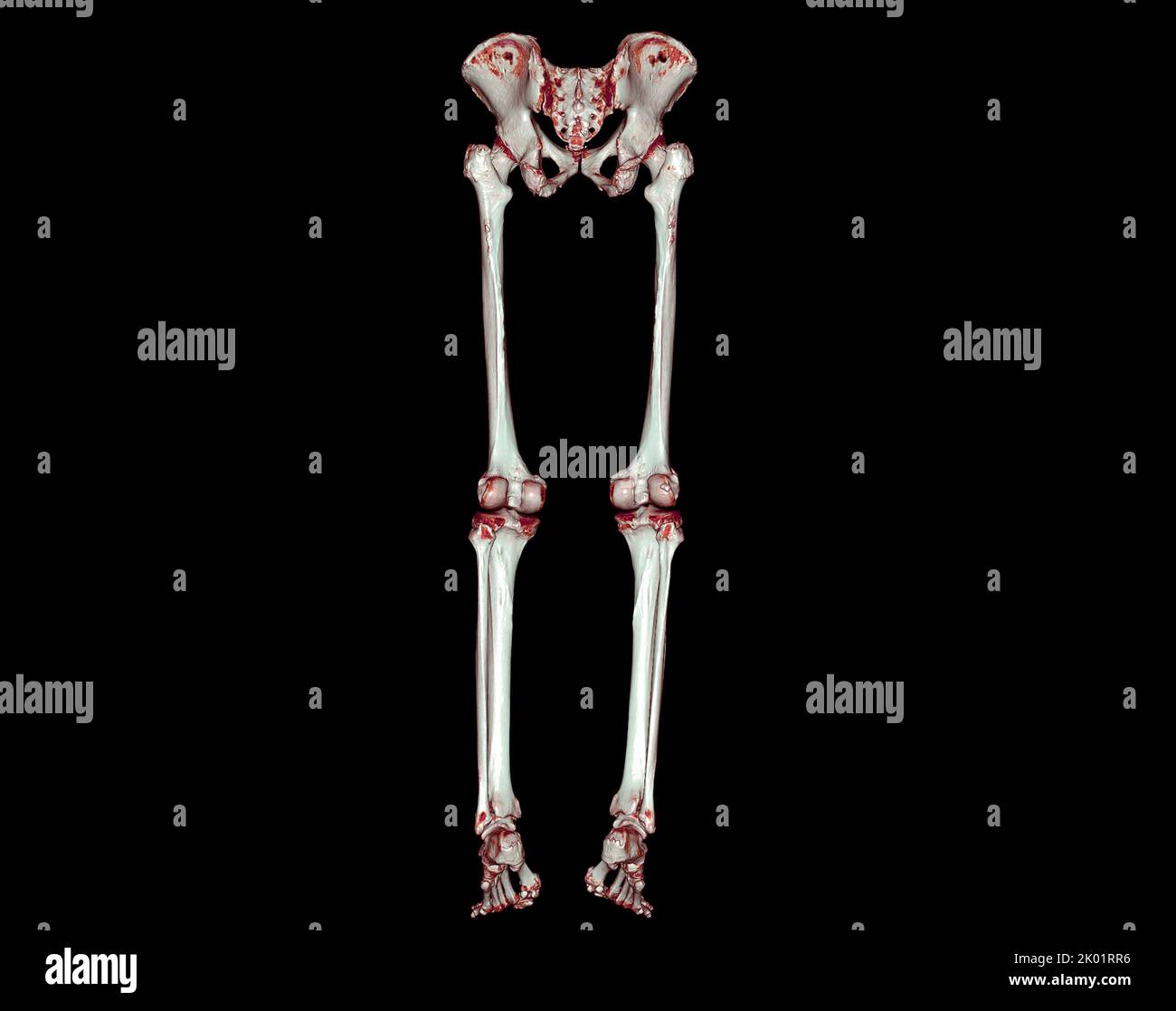 CT scan of lower extremity 3D for diagnosis fracture of Femur bone ...