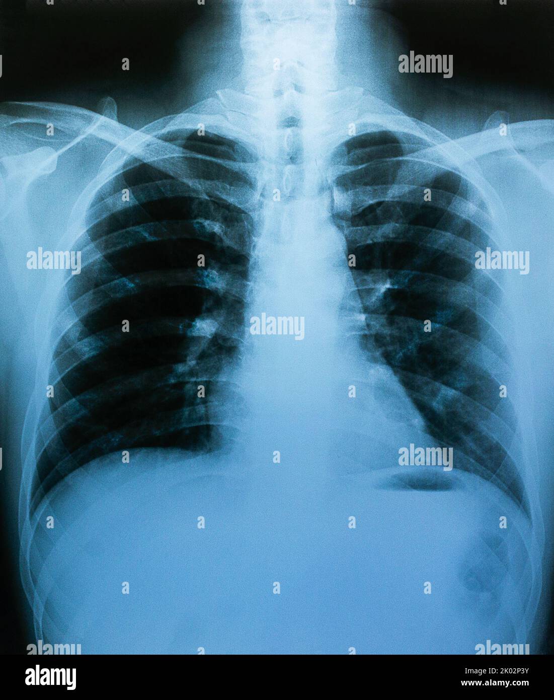 X-ray film, lung and bone structure, health examination Stock Photo
