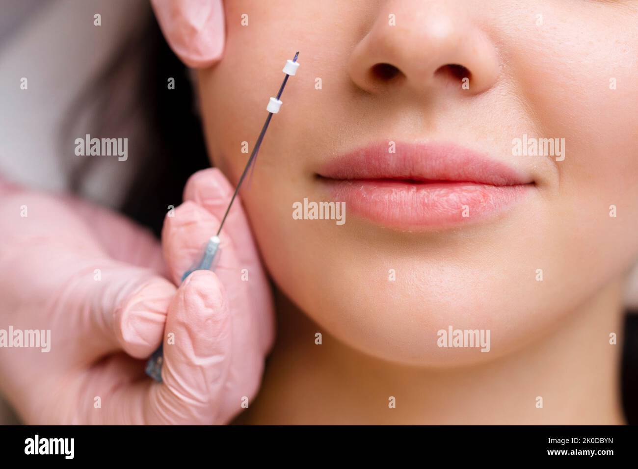 Face lifting PDO Suture operation. innovative technique of New thread