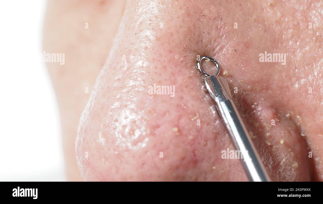 Acne and problem pores. Squeezing blackhead pimple with stainless steel