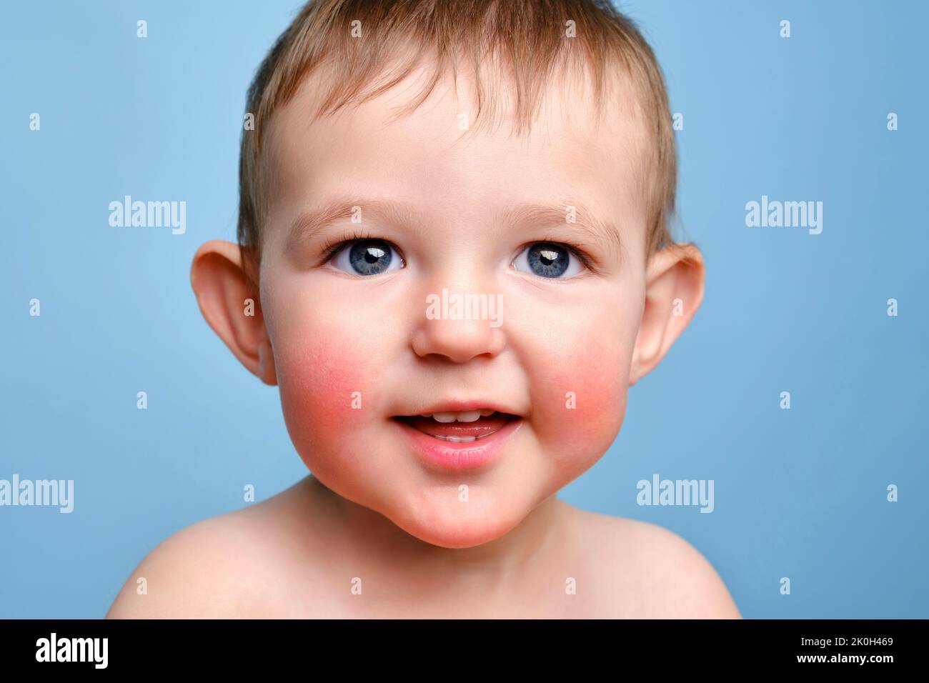 Happy toddler baby with allergies on her face, blue studio background