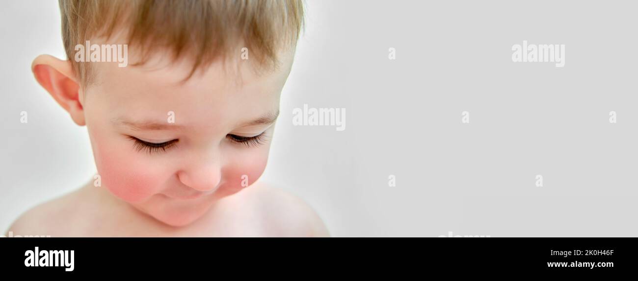 Portrait of a child with allergies on the cheeks and chin. Toddler baby