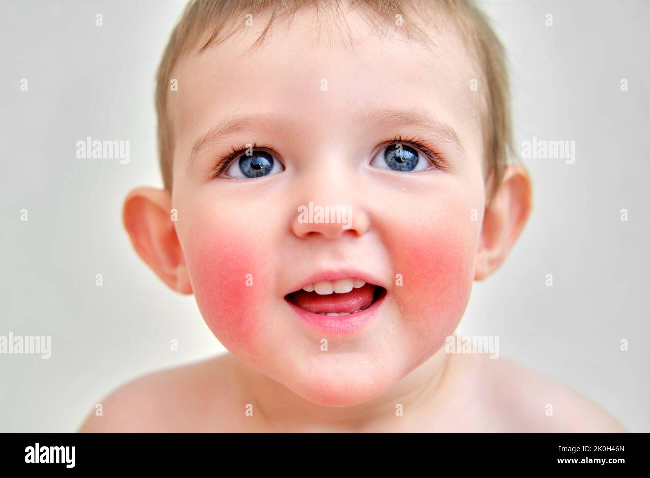 Portrait of a child with allergies on the cheeks and chin. Toddler baby
