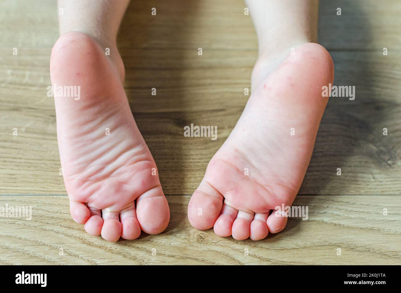 Enterovirus Feet Rash on the body of a child. Cocksackie virus rash