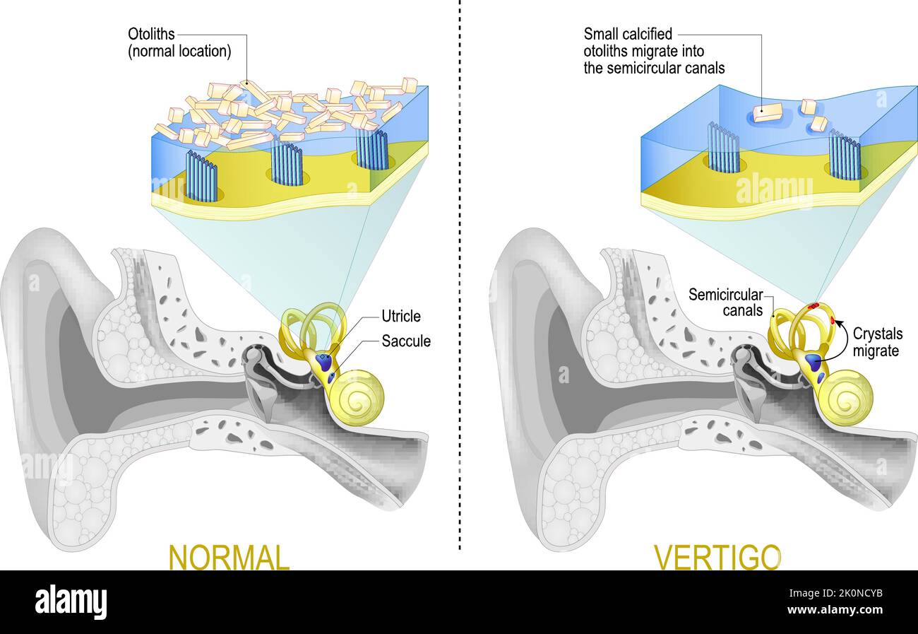 Benign paroxysmal positional vertigo. BPPV. labyrinth of the inner ear with Semicircular canals. Comparison between Normal vestibular system Stock Vector