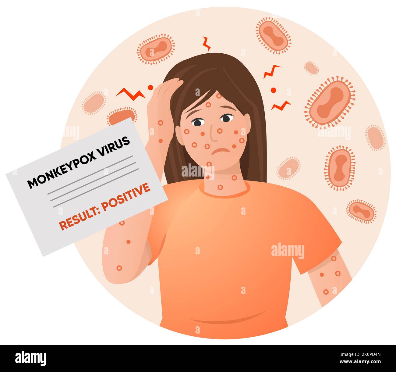 Sick woman with rash on her face and hands and monkeypox virus positive test result. Vector illustration Stock Vector