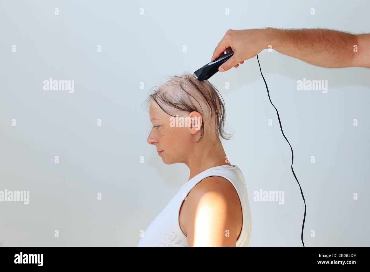 consequences of chemotherapy. Shaving off the last hair on the head with a razor. Head and razor. Total alopecia in a woman. bald head Stock Photo