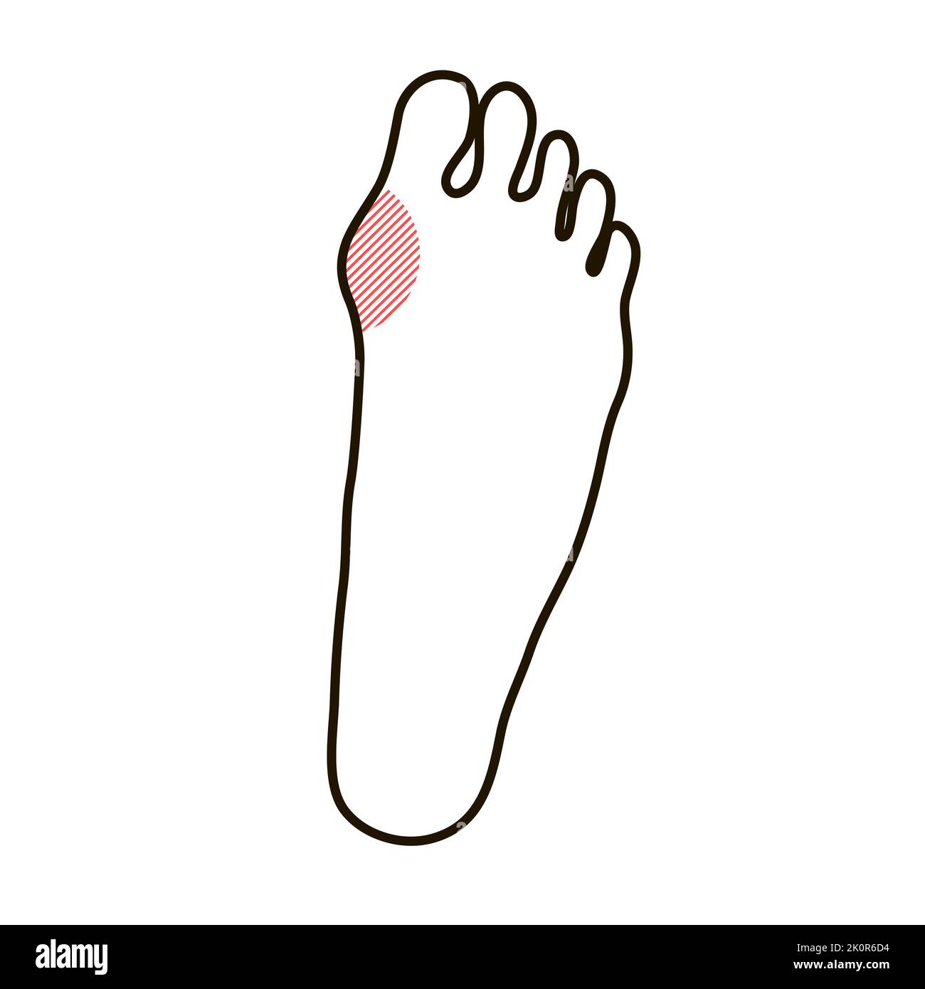Hallux valgus problem on the leg. Orthopedic deformity of the joint and