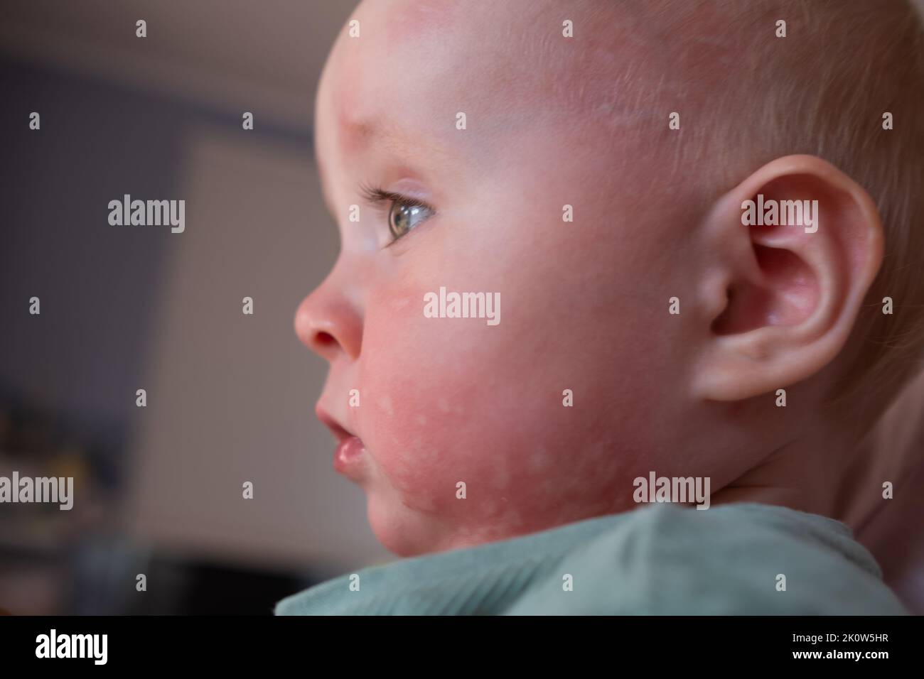 Nettle rash allergy on face in a caucasian toddler face. Stock Photo