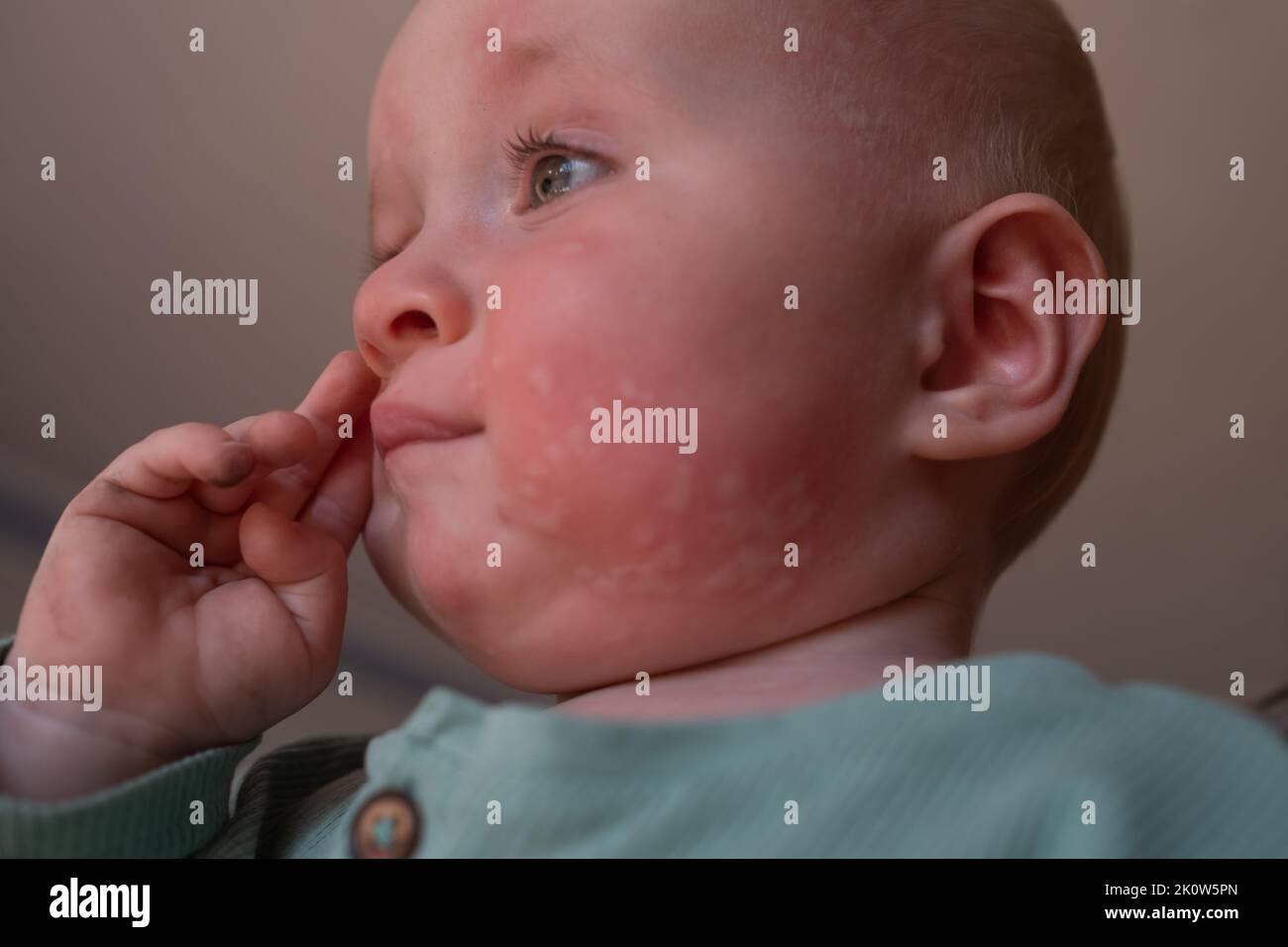 Nettle rash allergy on face in a toddler face. Stock Photo