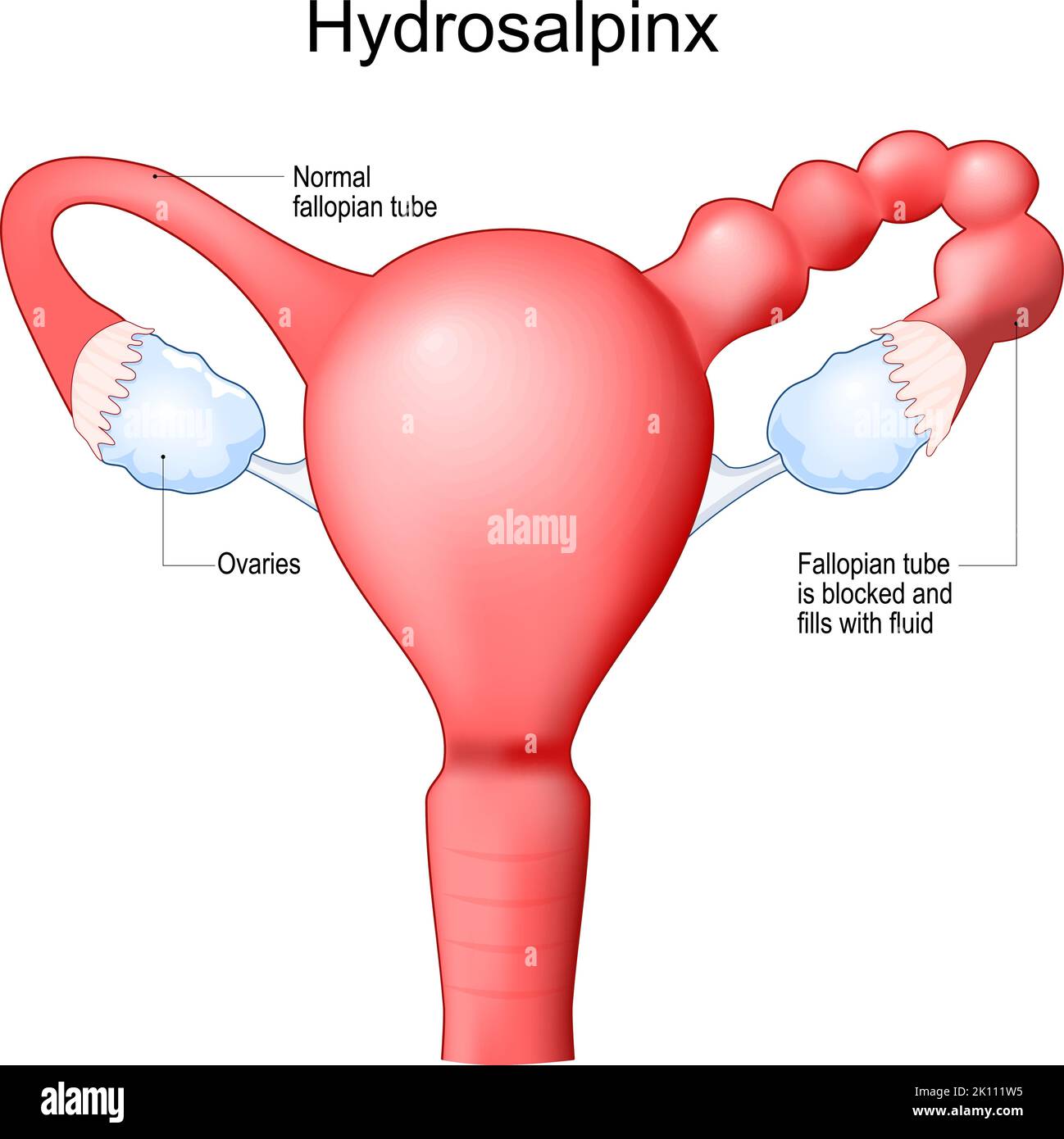 Human uterus with blocked of Fallopian tube. Hydrosalpinx cause infertility. Female reproductive system. Frontal view. Human anatomy. Realistic Stock Vector