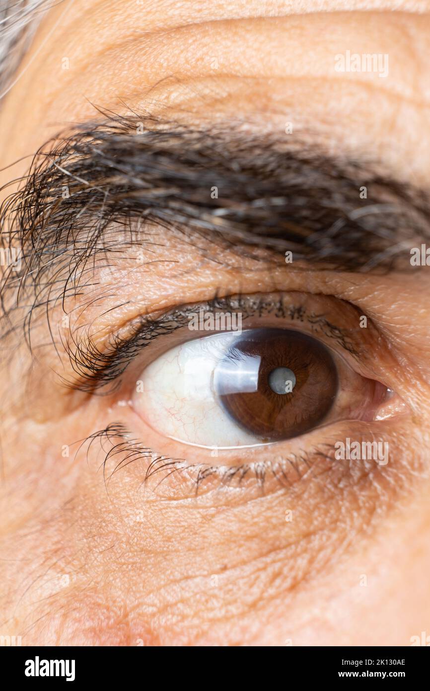 Eye of an elderly man with cataracts, clouding of the lens, macro. Stock Photo