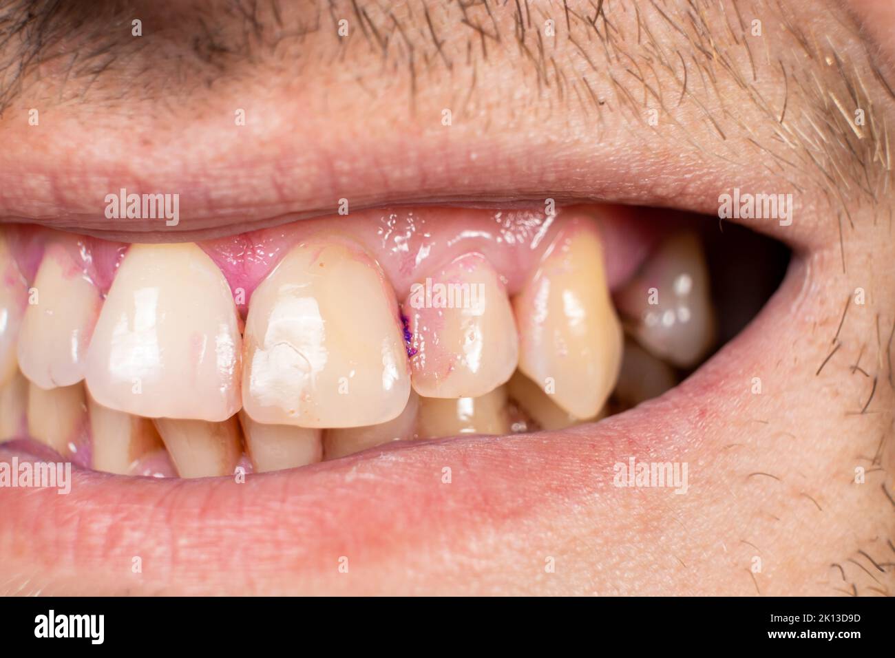 Plaque on human teeth is colored pink with indicator tablets Stock