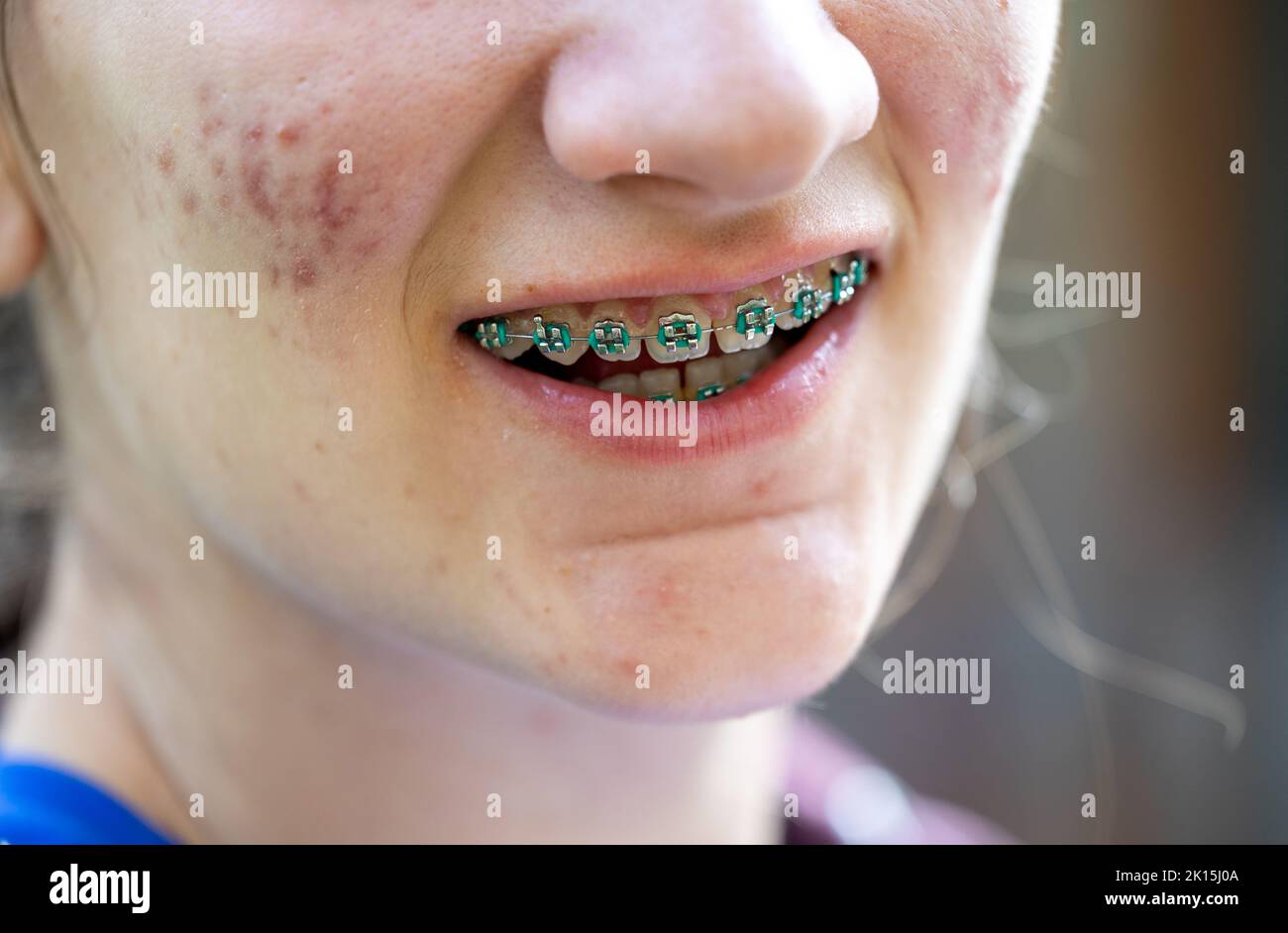 Close up of teenage girl's teeth with blue metal braces. Correction of