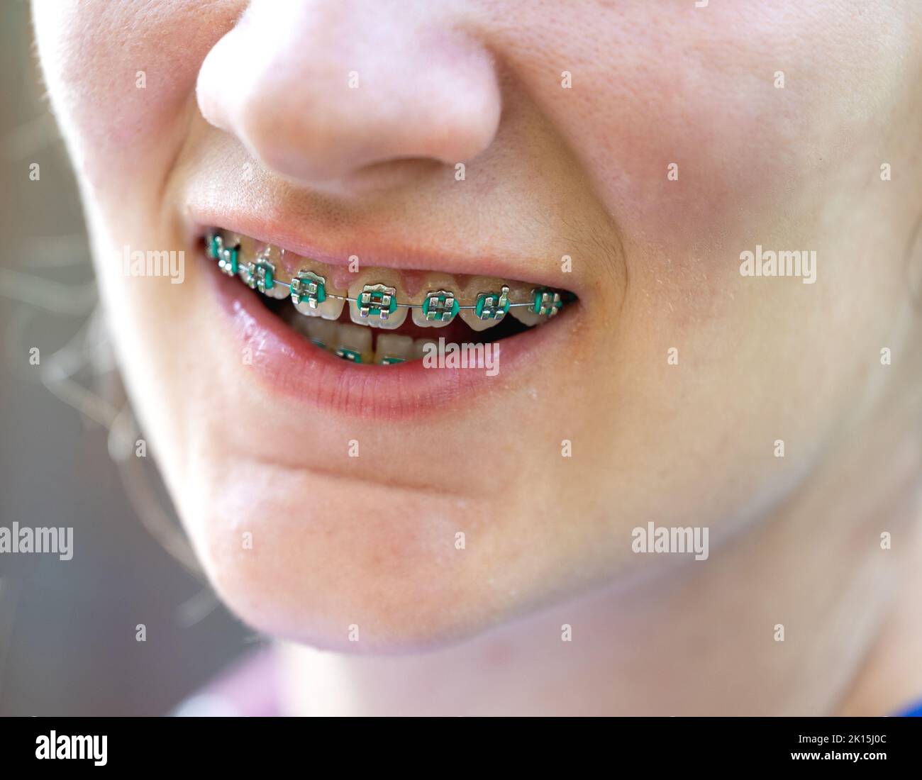 Close up of teenage girl's teeth with blue metal braces. Correction of bite. Dental care concept Stock Photo