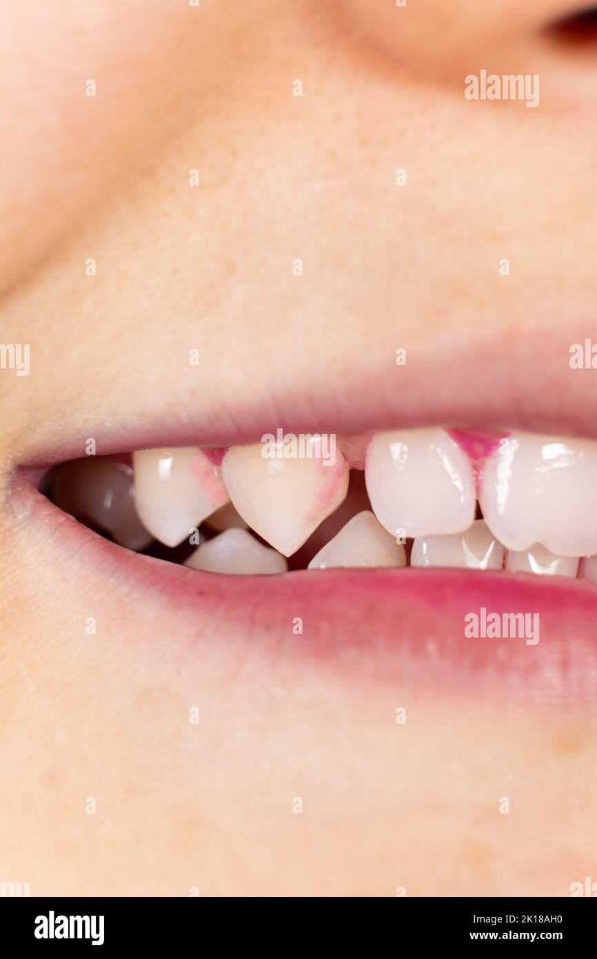 Plaque on human teeth is colored pink with indicator tablets. Stock Photo