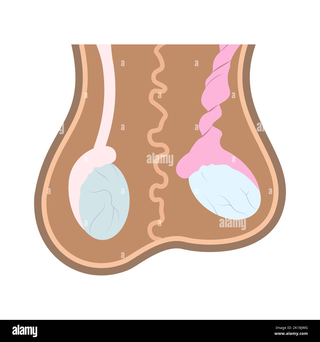 Illustration of normal testicle and testicle torsion in scrotum. Medical chart of reproductive organ anatomy. Stock Vector