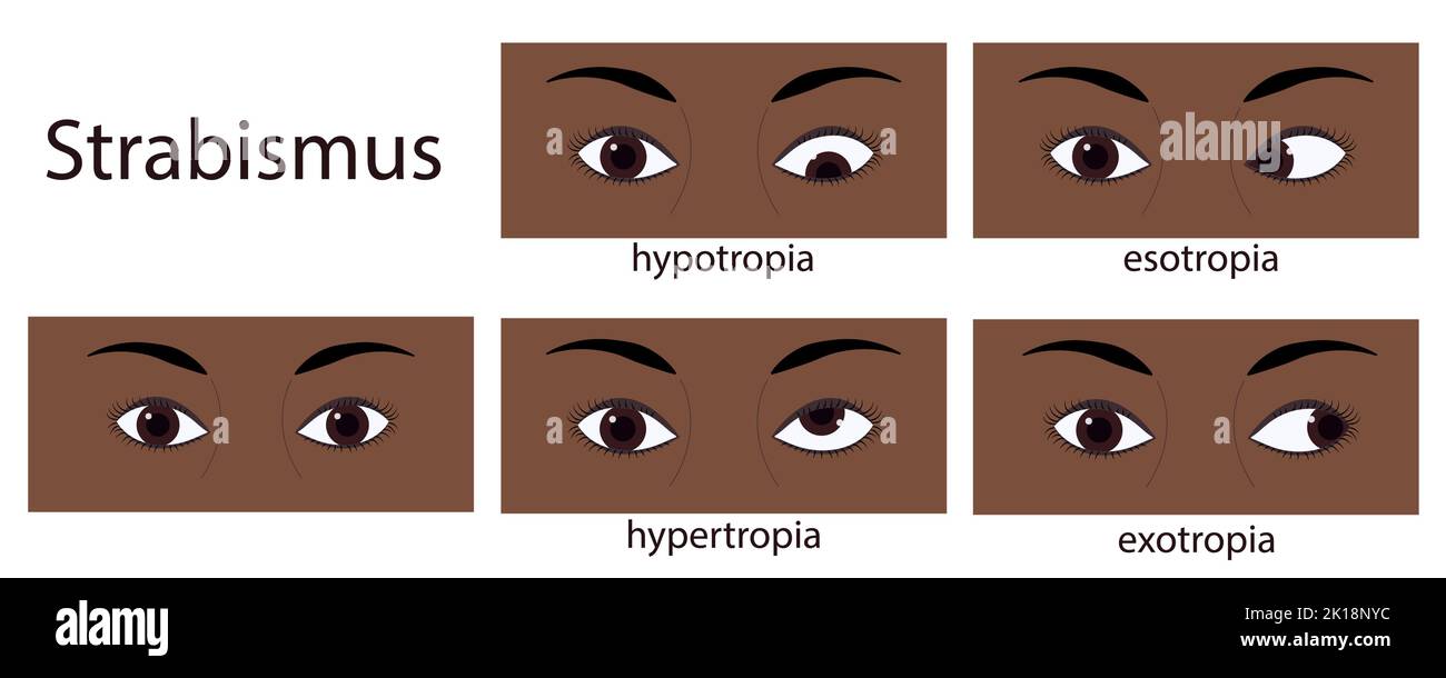 Strabismus flat style infographic set of stages: normal and disorders. Eyes of human with dark skin Stock Vector