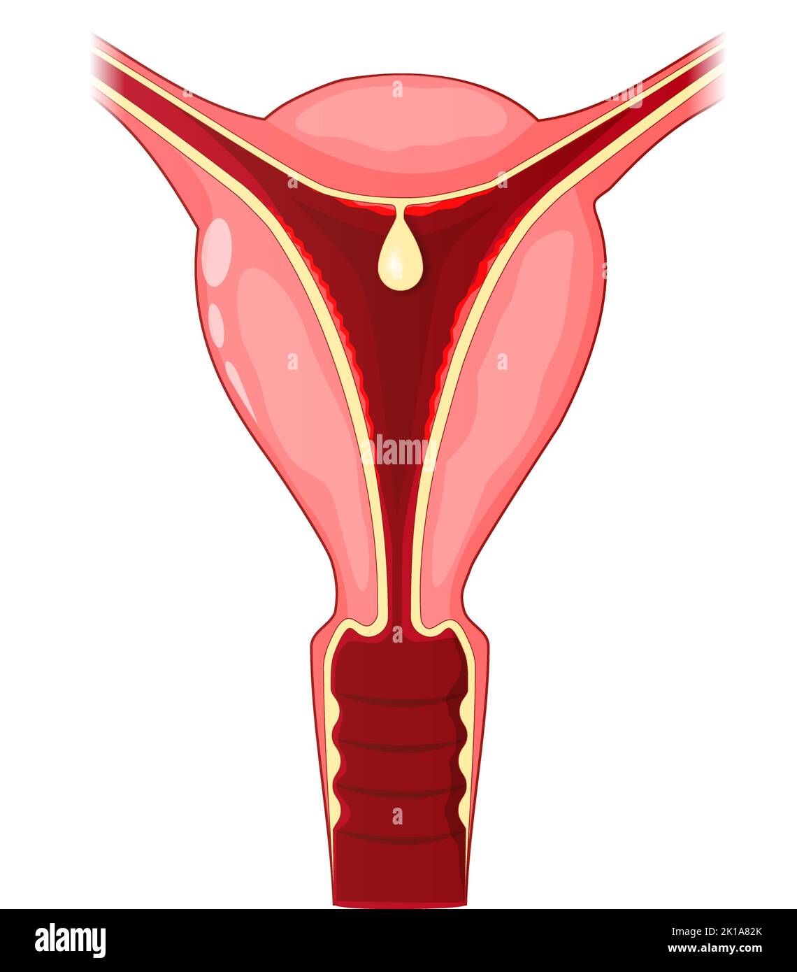 Uterine polyp. Human uterus with Endometrial polyp that attached to the uterus by an elongated pedicle. Vector poster. Stock Vector