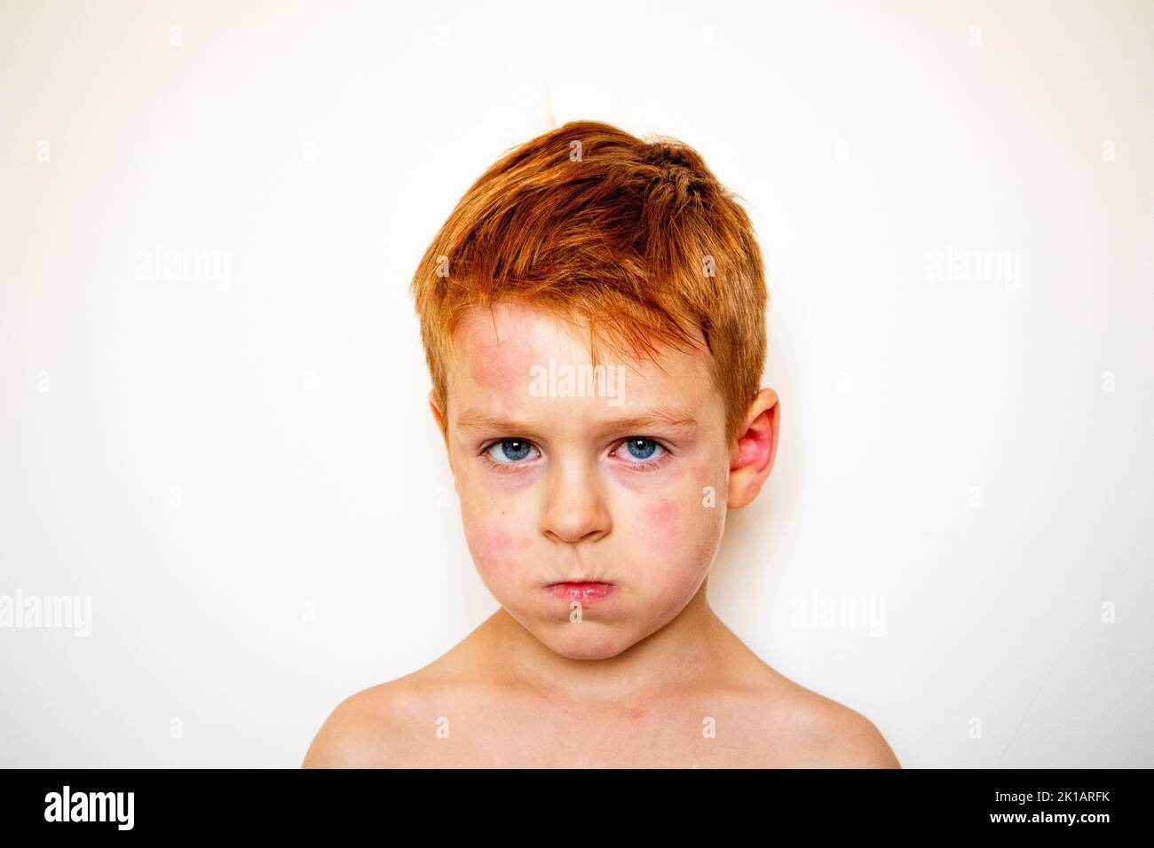 portrait of a boy with allergies. red sick child's eyes. blotchy face Stock Photo Alamy