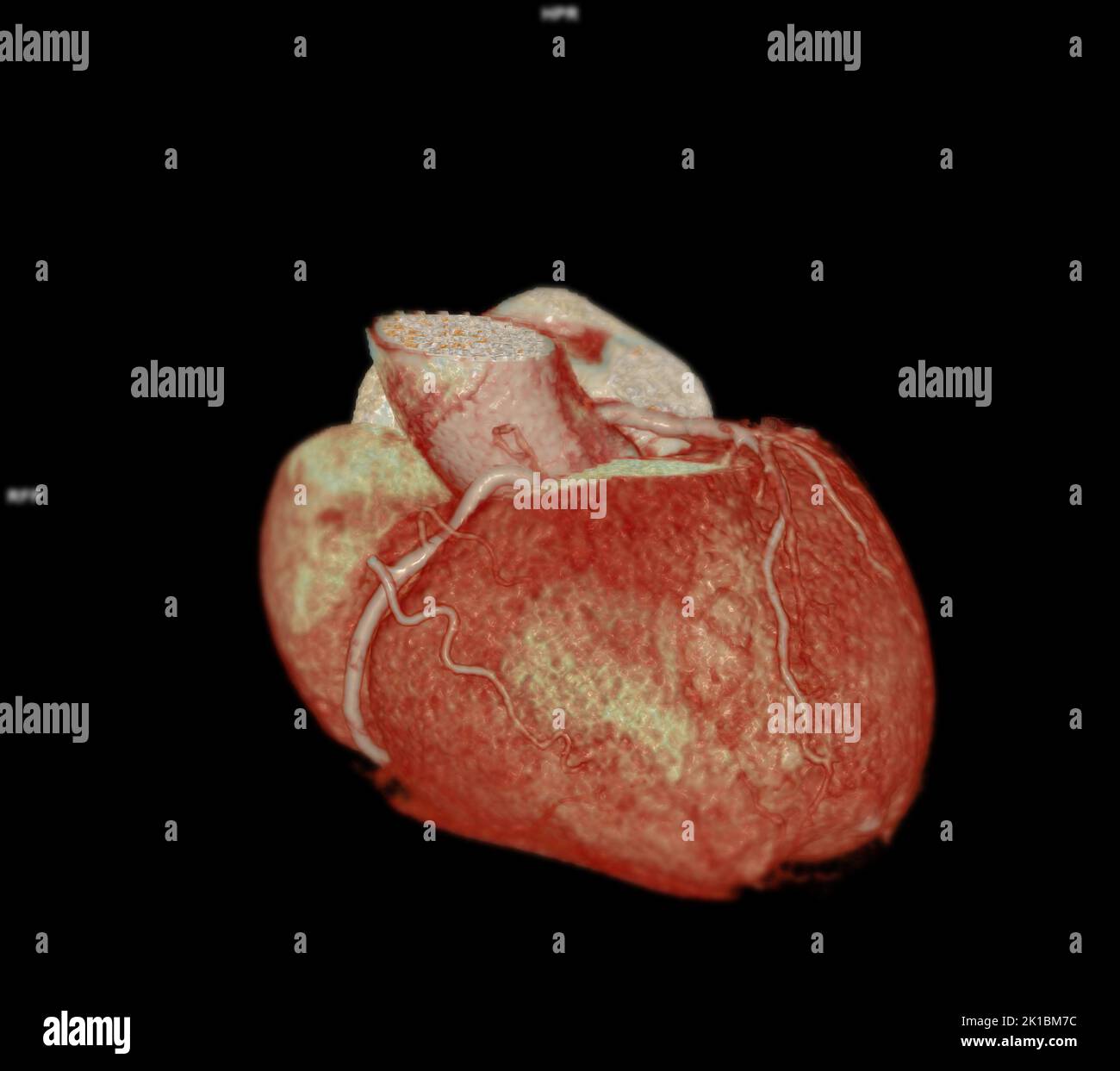 CT Cardiac 3D or CTA coronary artery for prevention coronary artery diseases. Stock Photo