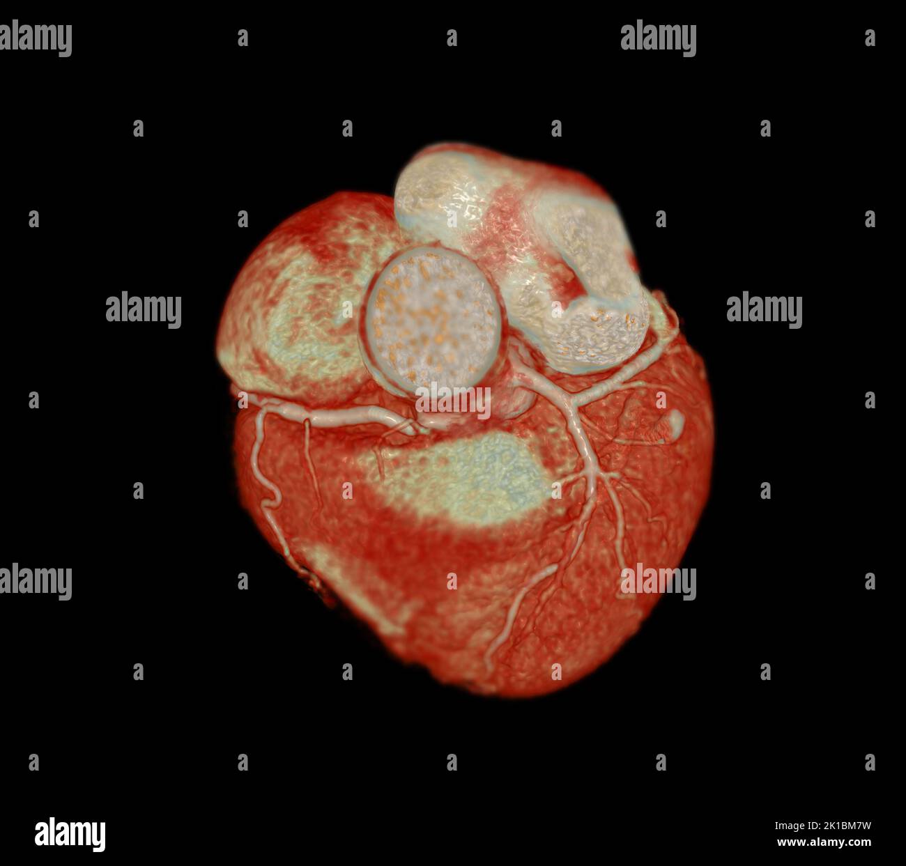 CT Cardiac 3D or CTA coronary artery for prevention coronary artery diseases. Stock Photo