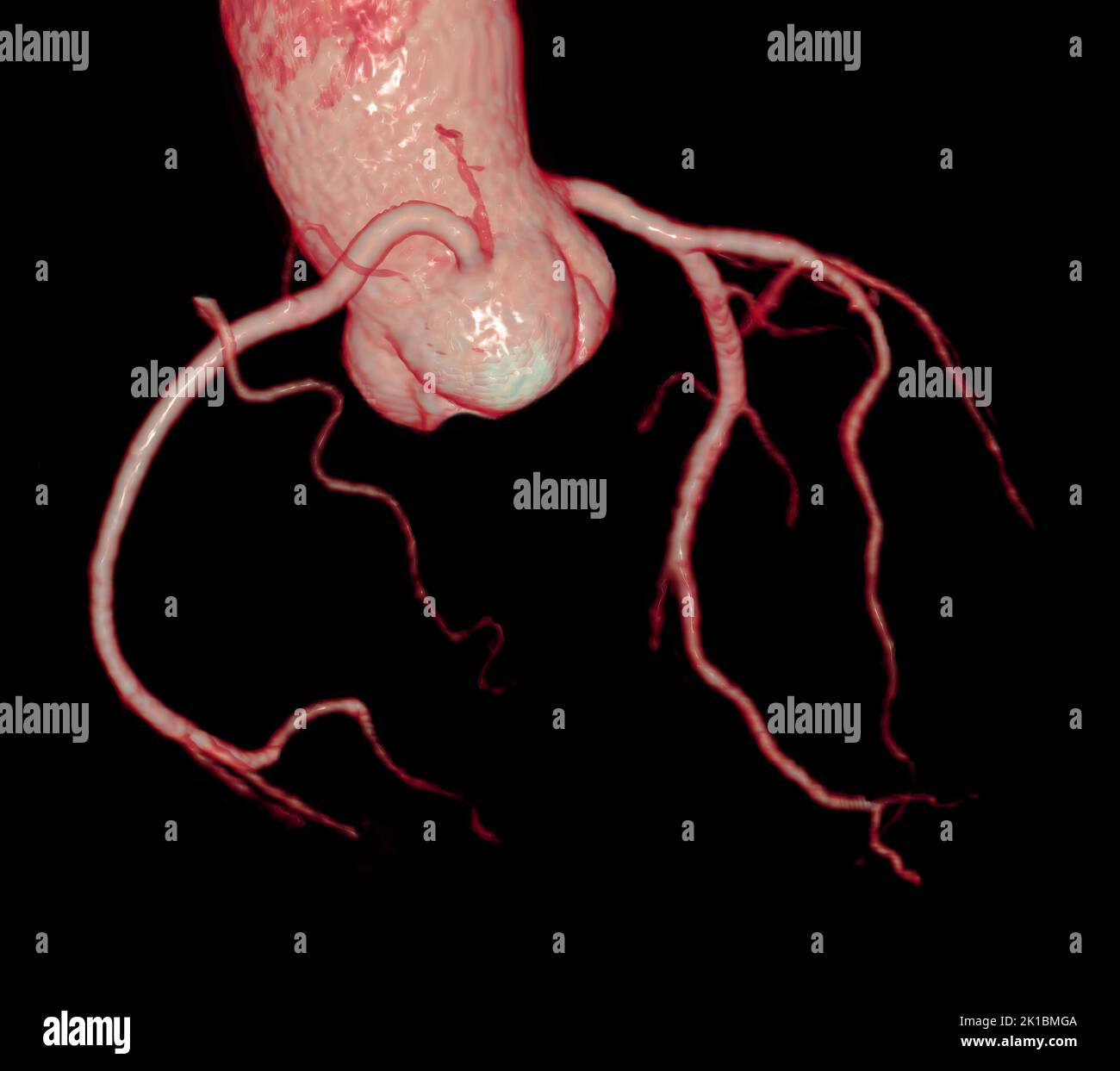 CT Cardiac 3D or CTA coronary artery for prevention coronary artery diseases. Stock Photo
