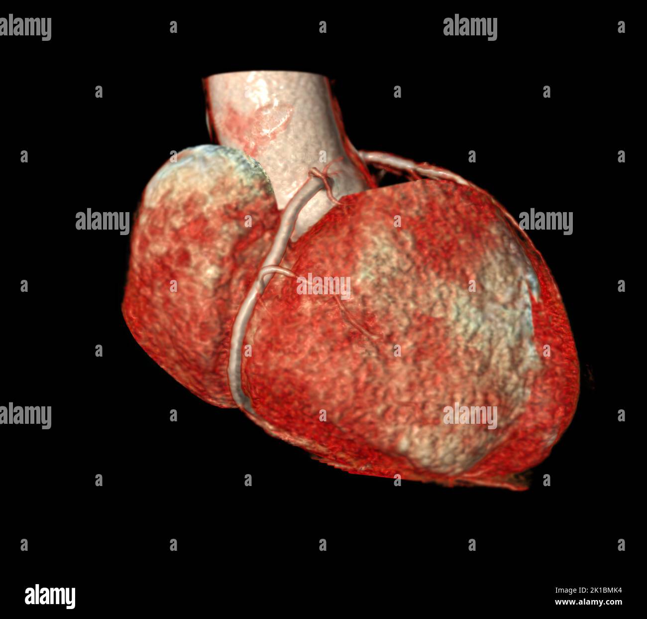 CT Cardiac 3D or CTA coronary artery for prevention coronary artery