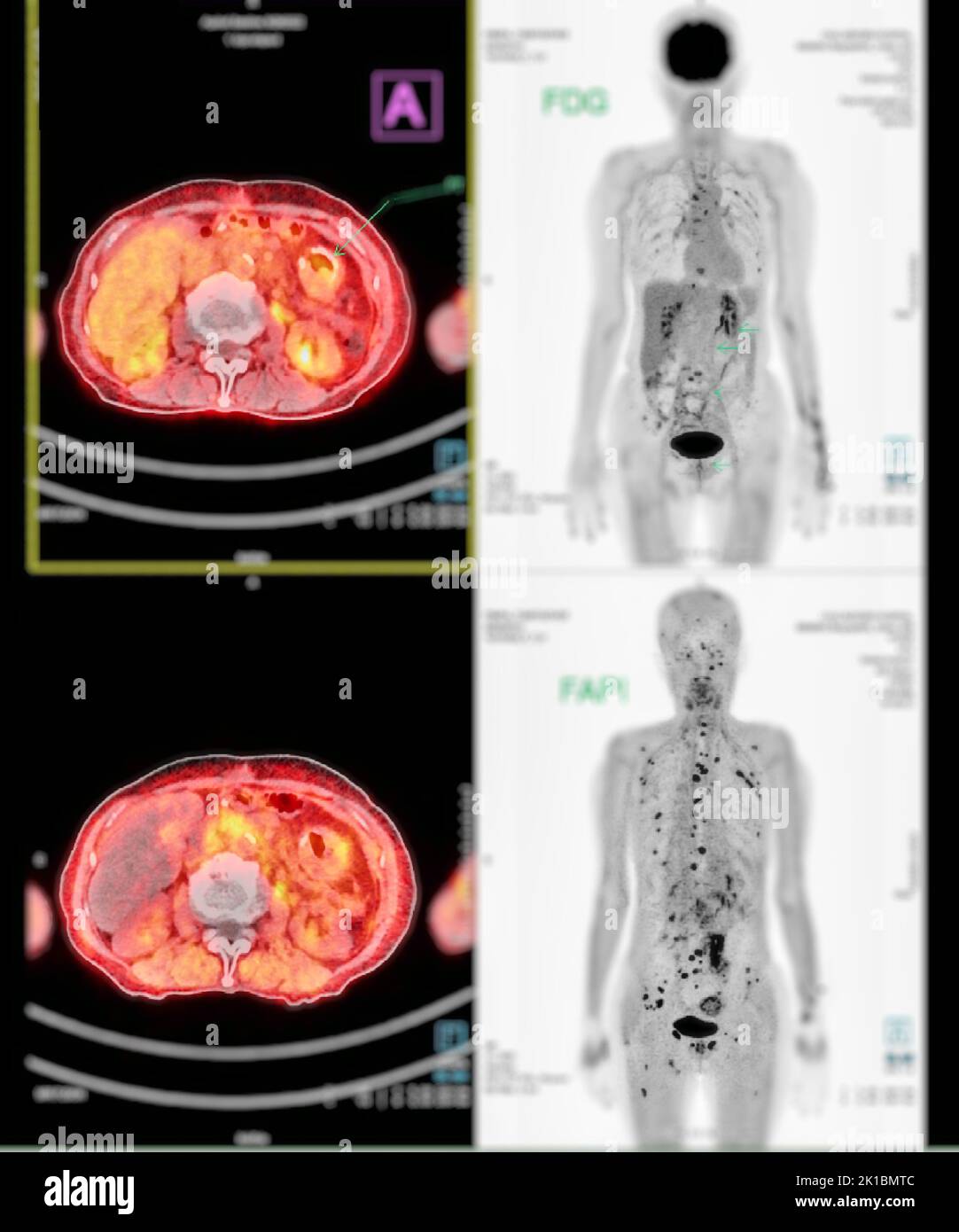 Whole body mri scan hires stock photography and images Alamy