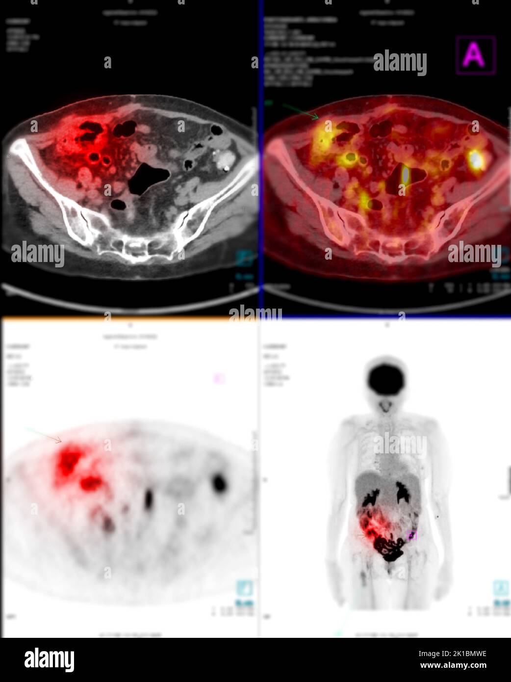 https://c8.alamy.com/comp/2K1BMWE/positron-emission-tomography-pet-ct-scan-uses-a-radioactive-drug-tracer-to-show-both-normal-and-abnormal-metabolic-activity-of-whole-human-body-2K1BMWE.jpg