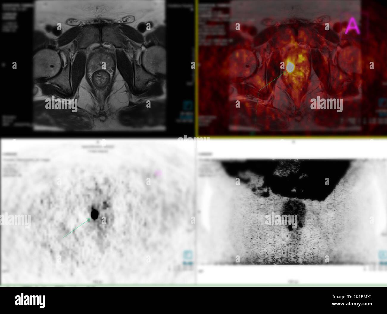 Positron emission tomography (PET) CT scan uses a radioactive drug ...