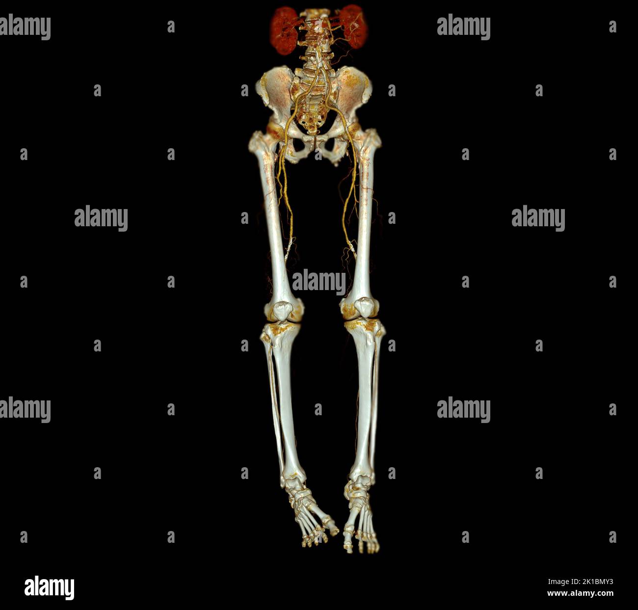 CTA femoral artery run off 3D rendering image of femoral artery