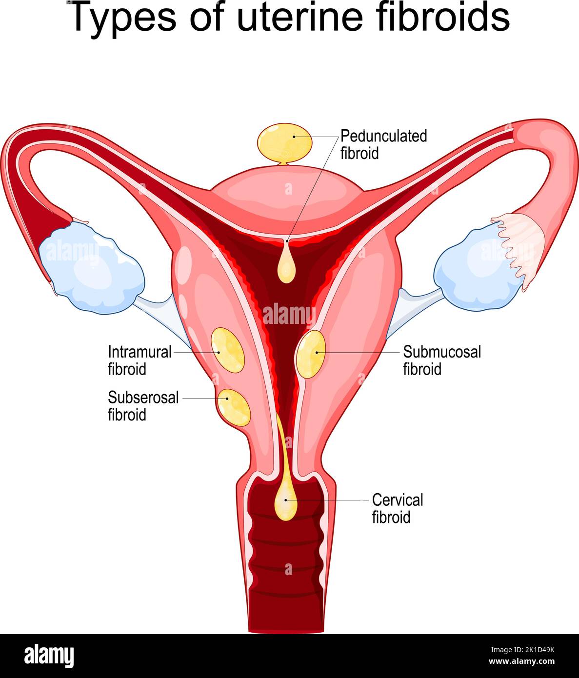 Uterine fibroids. subserosal, intramural, submucosal, and pedunculated fibroids. benign tumors. myoma. Female reproductive system . Vector Stock Vector