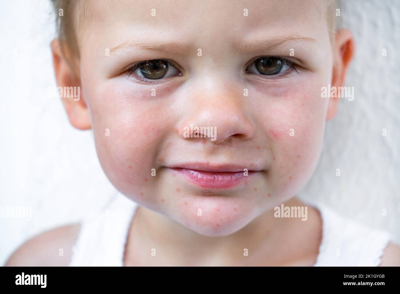 Enterovirus Leg - Arm - Mouth. Rash On The Body Of A Child. Cocksackie ...