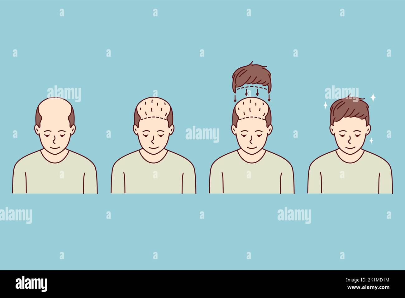 Stages on man hair transplant. Treatment of baldness and alopecia. Set of male patient follicular unit extraction. Vector illustration.  Stock Vector