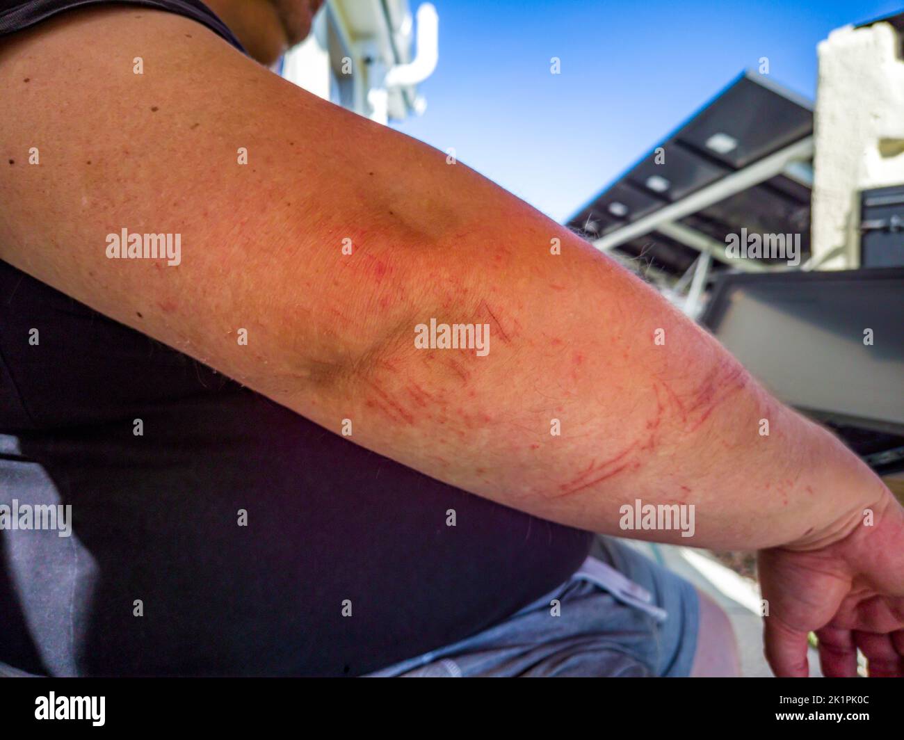 Scratchedd male arm after an accident. Stock Photo