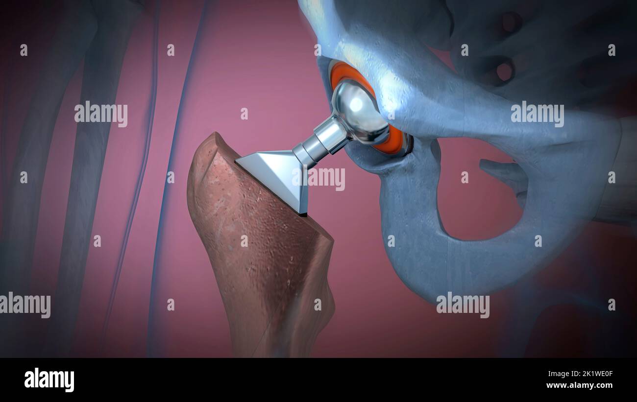 Hip replacement, illustration Stock Photo Alamy