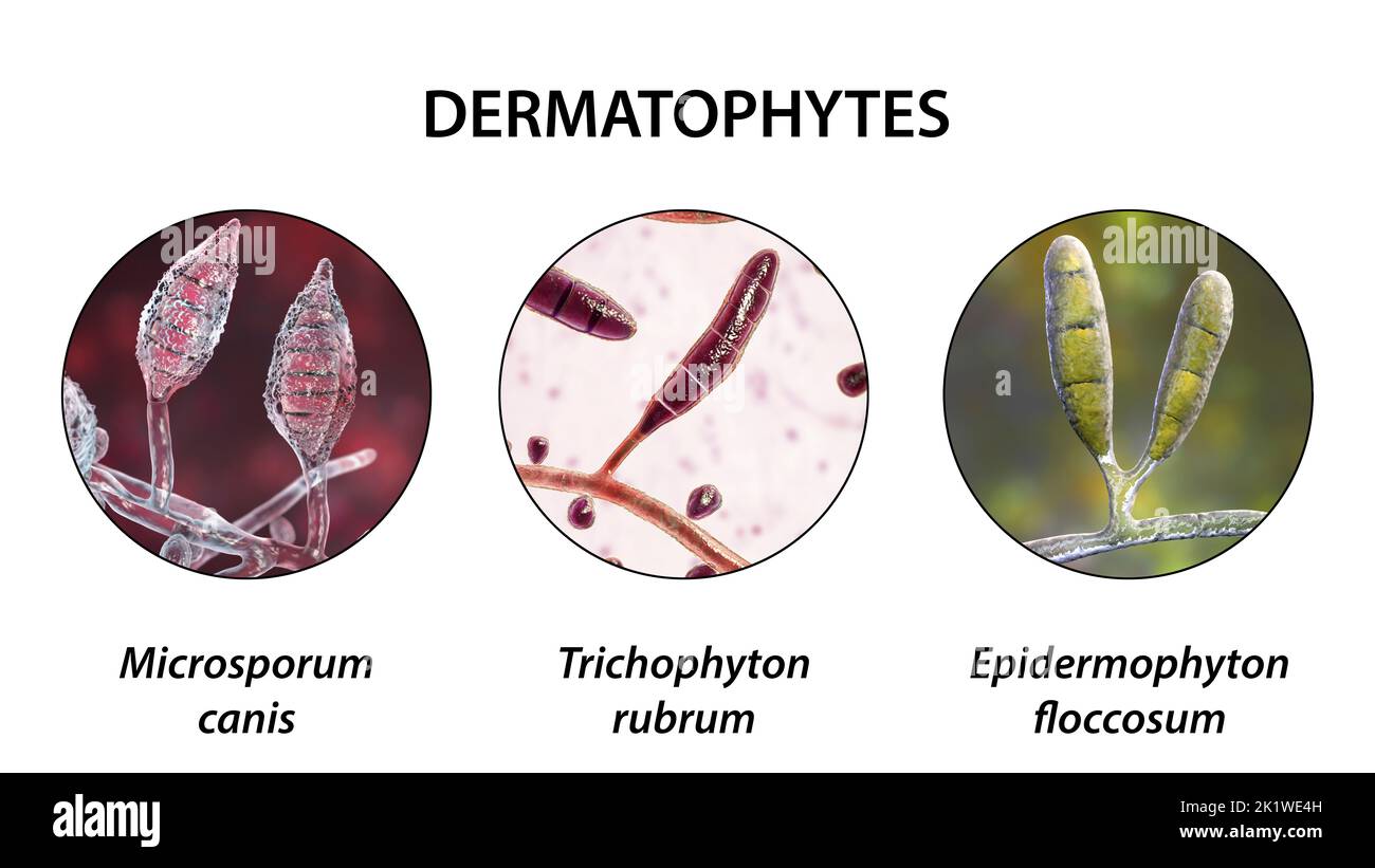 Dermatophyte fungi, illustration Stock Photo