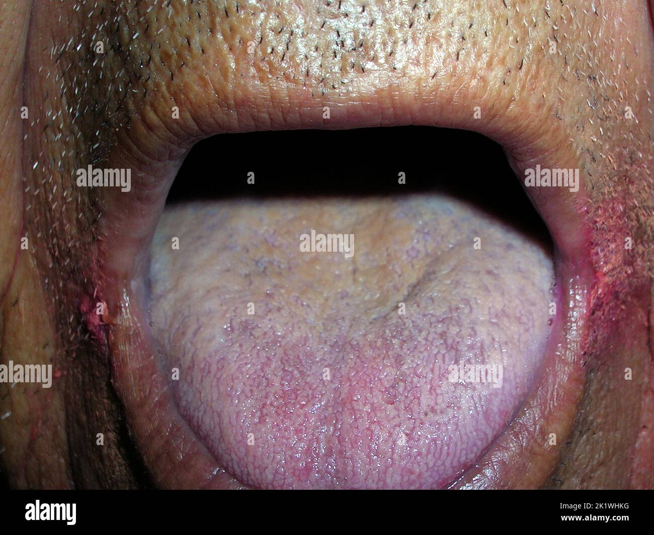Black hairy tongue and angular cheilitis Stock Photo Alamy