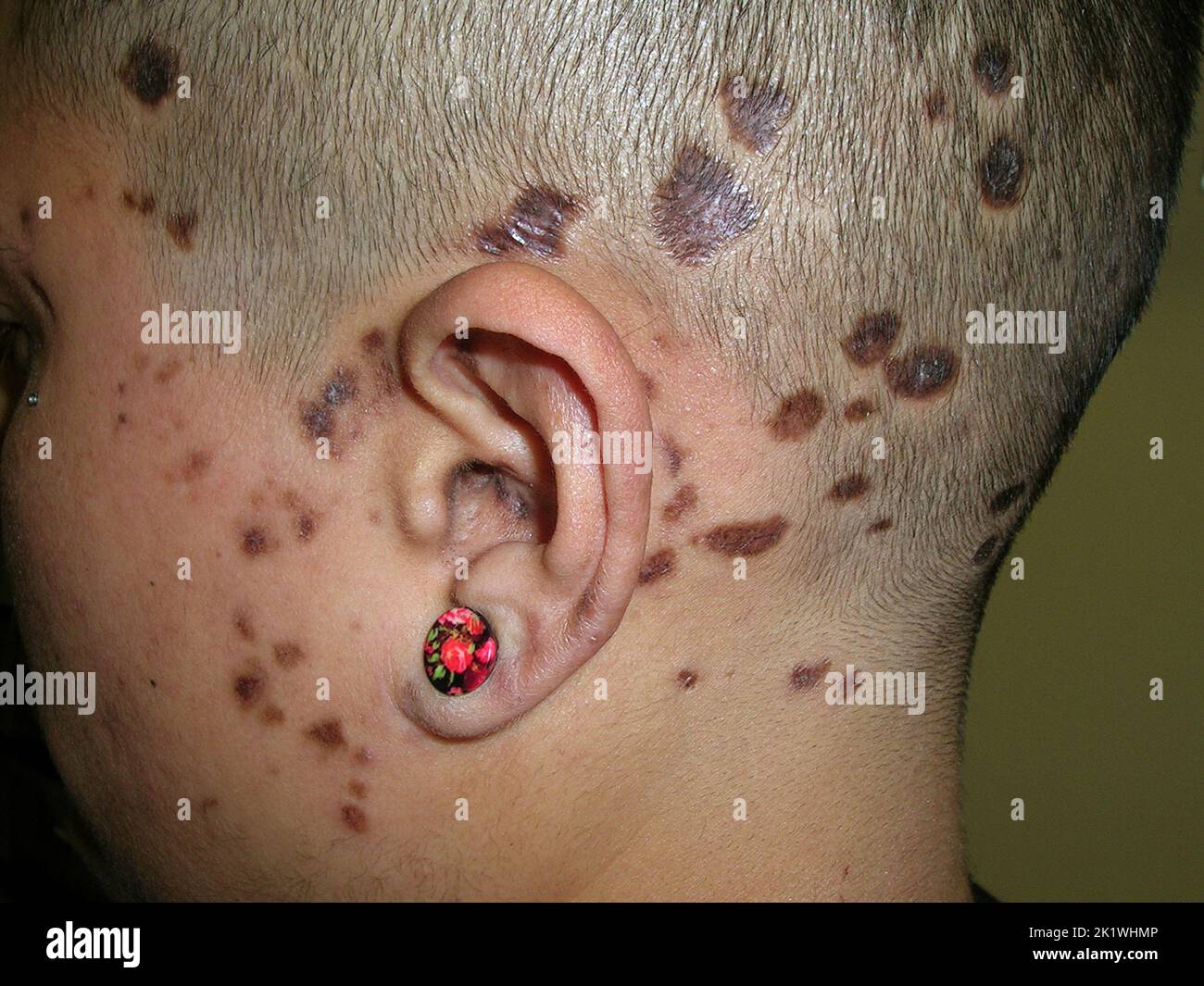 Discoid lupus erythematosus Stock Photo - Alamy