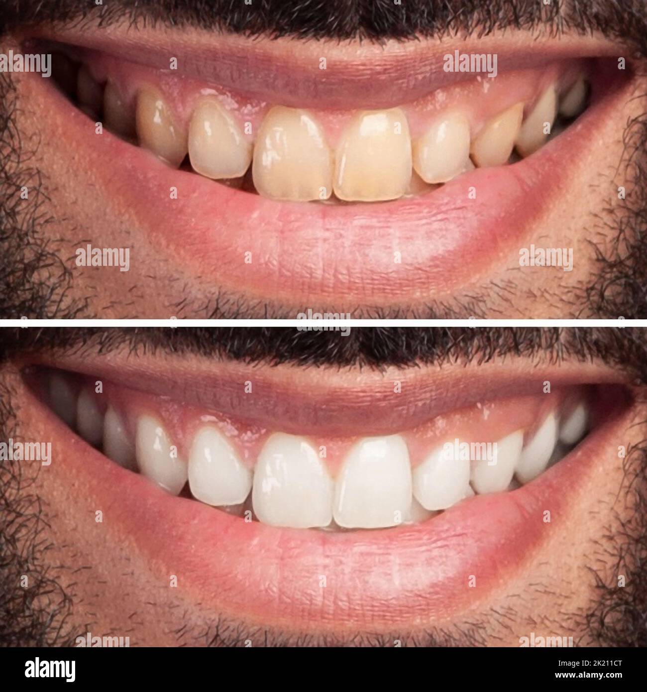 Closeup of man teeth before and after whitening or bleaching of smiling man. Dental health Concept. Oral Care concept Stock Photo