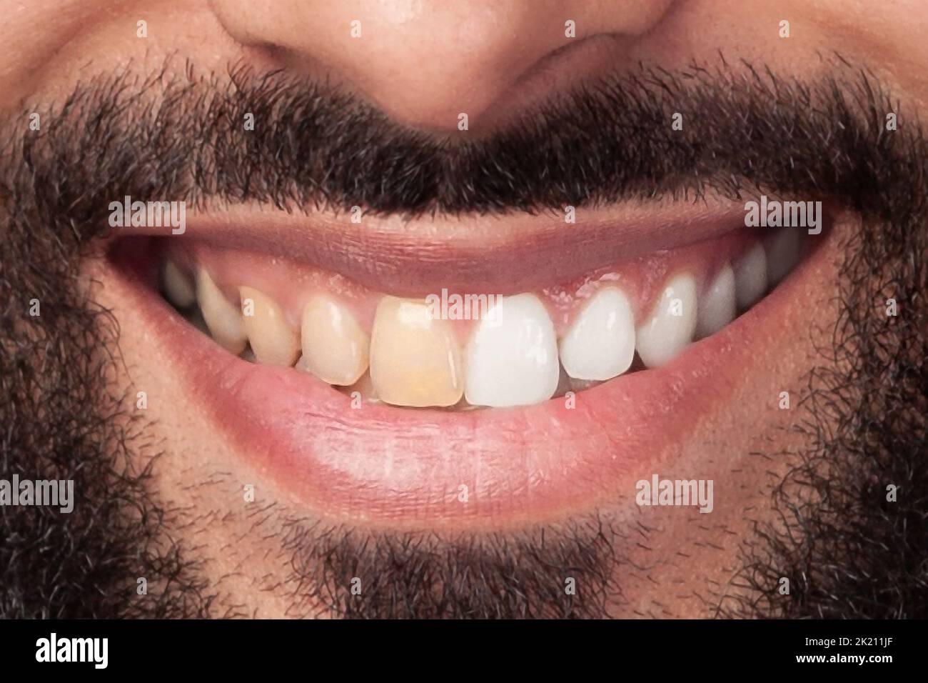Closeup of man teeth before and after whitening or bleaching of smiling man. Dental health Concept. Oral Care concept Stock Photo