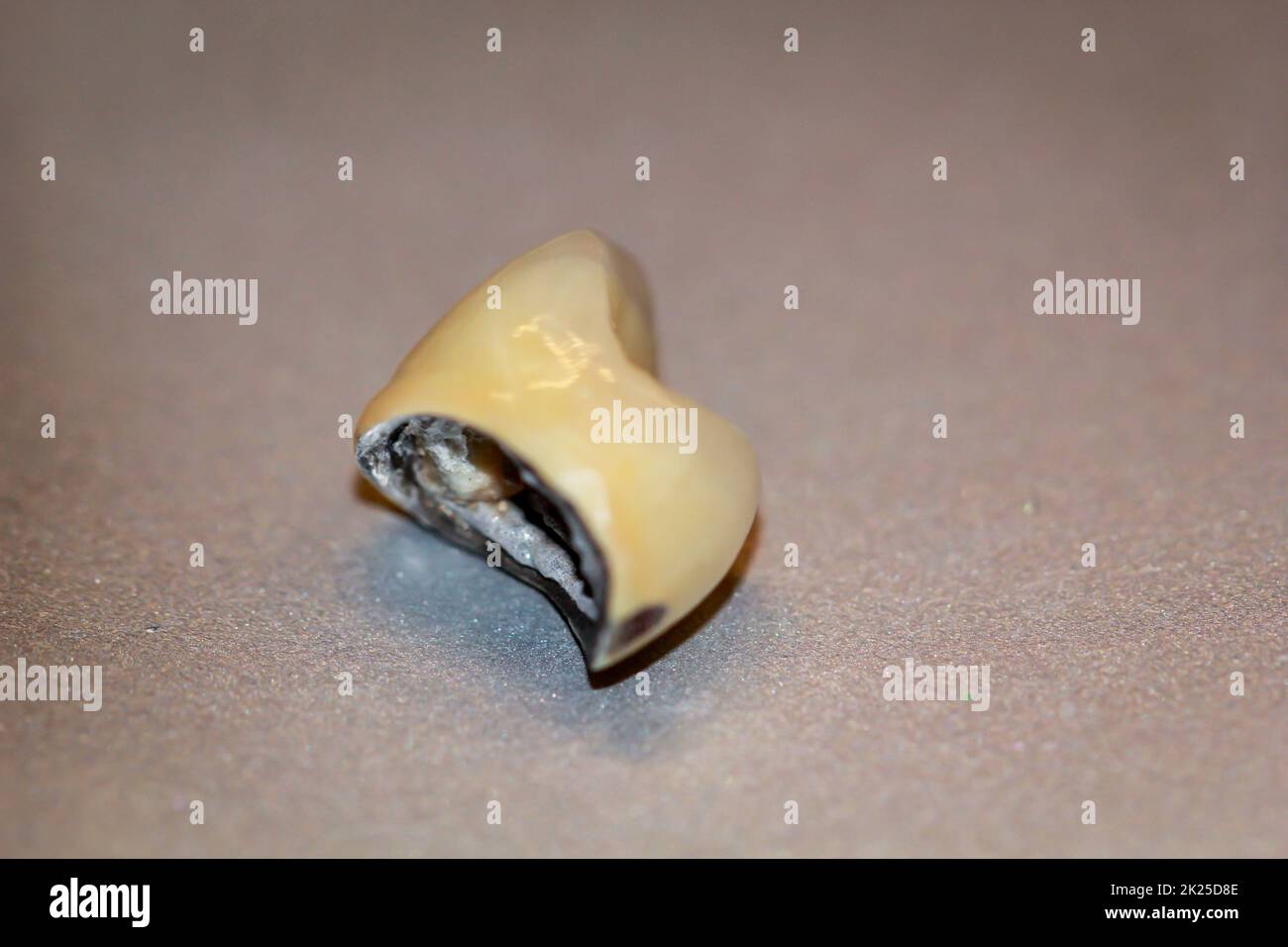 A loosened and fallen out crown of a tooth Stock Photo Alamy