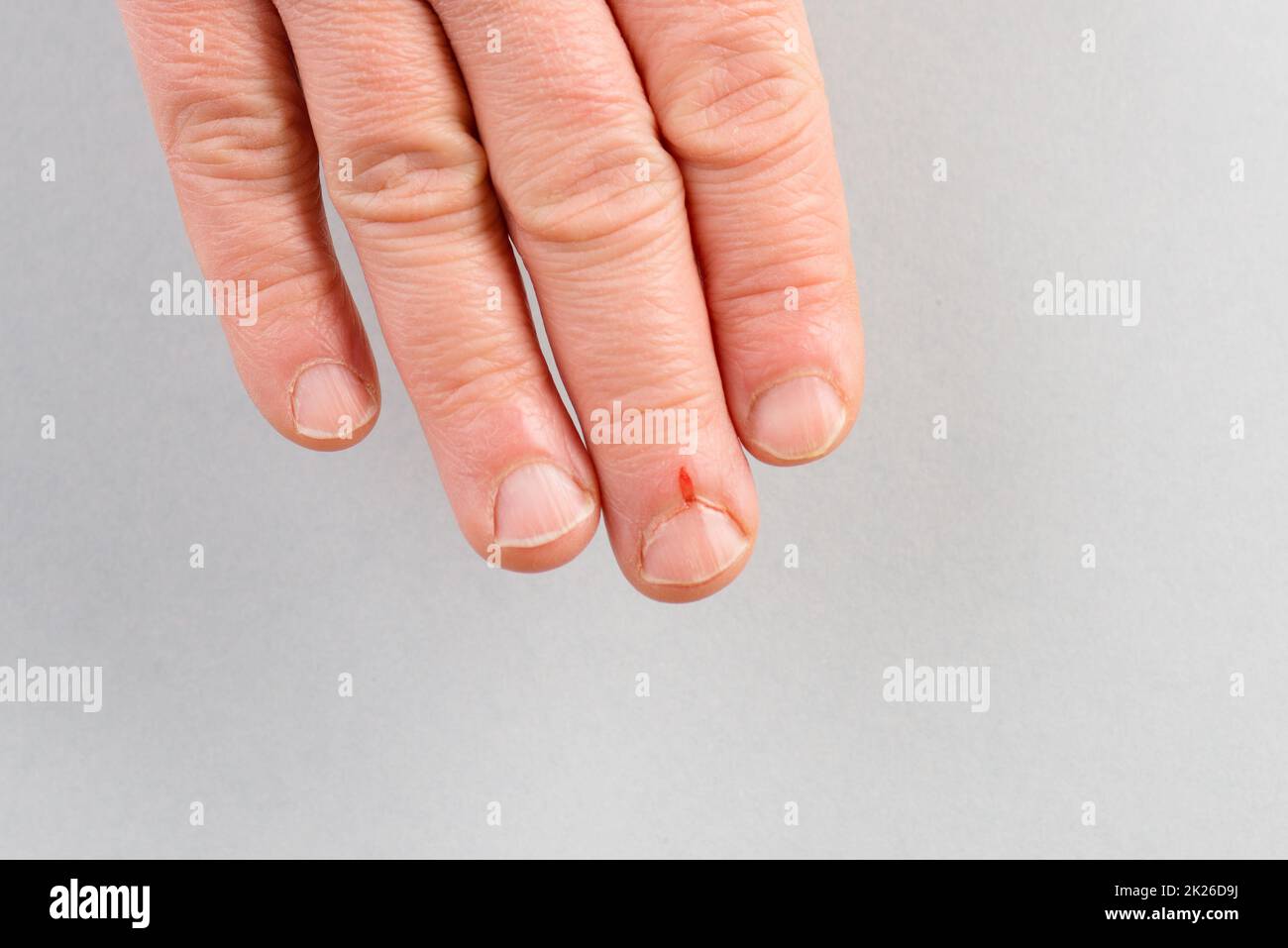 Small wound on the finger, fresh blood after injury, close up, bleeding