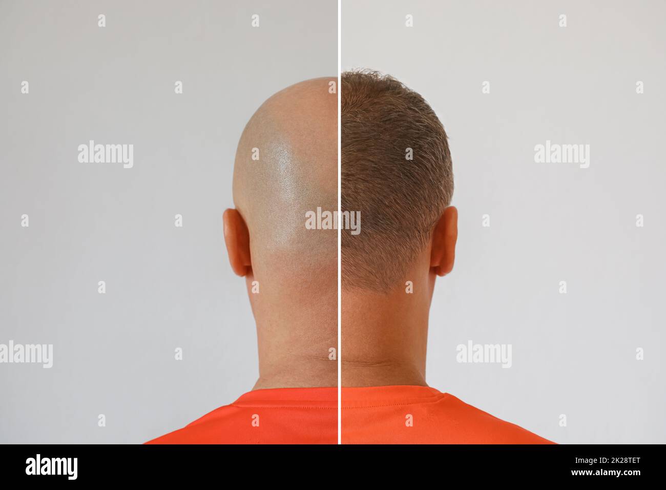 The head of a balding man before and after hair transplant surgery. A man losing his hair has become shaggy. An advertising poster for a hair Stock Photo