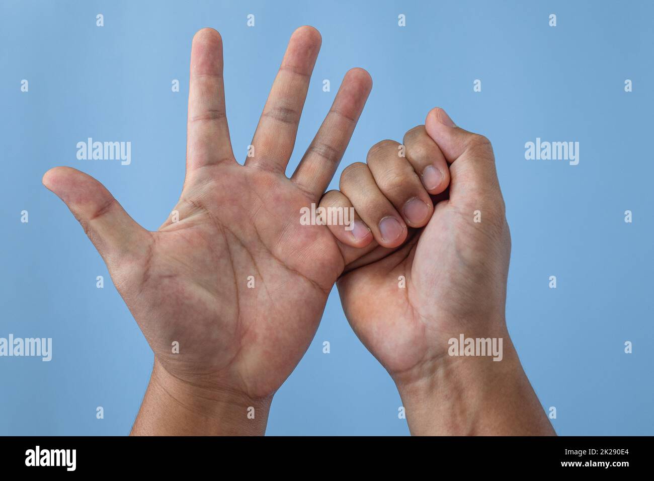 Little fingers, little problems! – Fife Virtual Hand Clinic